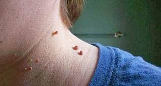 İşte et benlerini gideren bitkisel karışım...